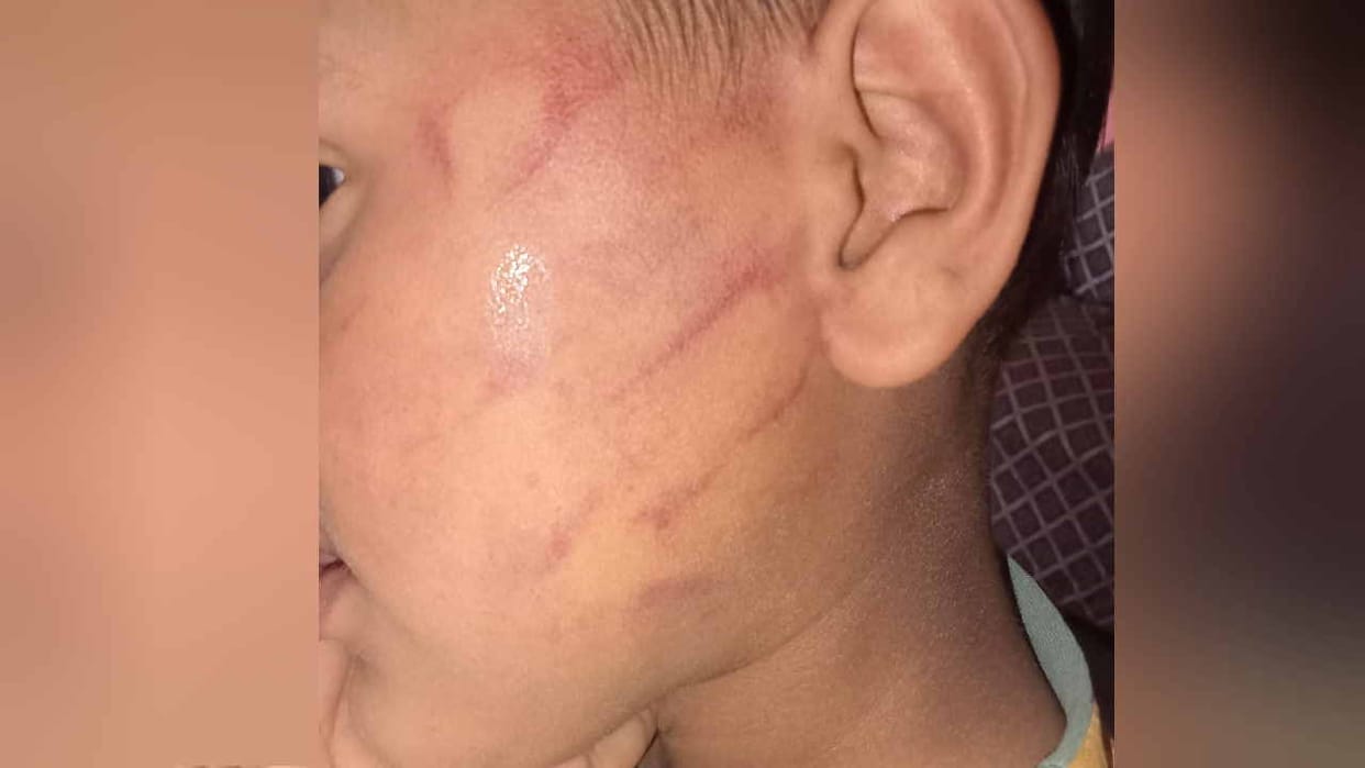 Ruthless beating of third class student, mark on cheek