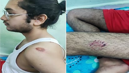 Neighbor leaves pet pitbull dog on student in Delhi s Timarpur boy injured in attack