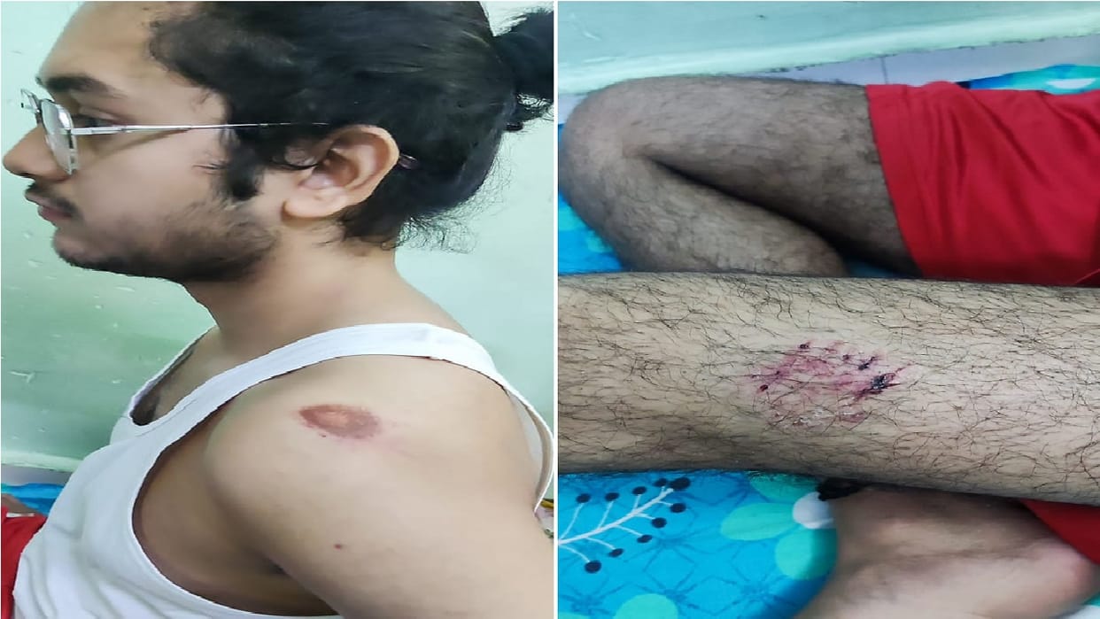 Neighbor leaves pet pitbull dog on student in Delhi s Timarpur boy injured in attack