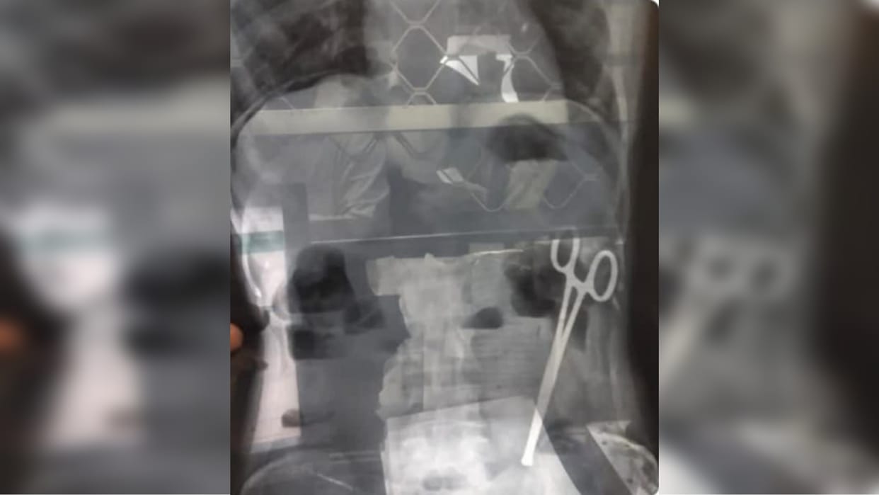 Doctors left scissors in woman's stomach during surgery at private hospital in Jaipur