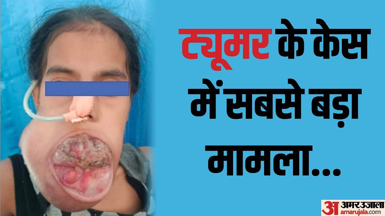 AIIMS did successful surgery of cancer in 14 year old girl jaw