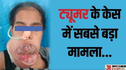 Hyper Parathyroidism: एम्स ने किया 14 साल की लड़की के जबड़े में हुए कैंसर की सफल सर्जरी, जानें कारण व लक्षण AIIMS did successful surgery of cancer in 14 year old girl jaw