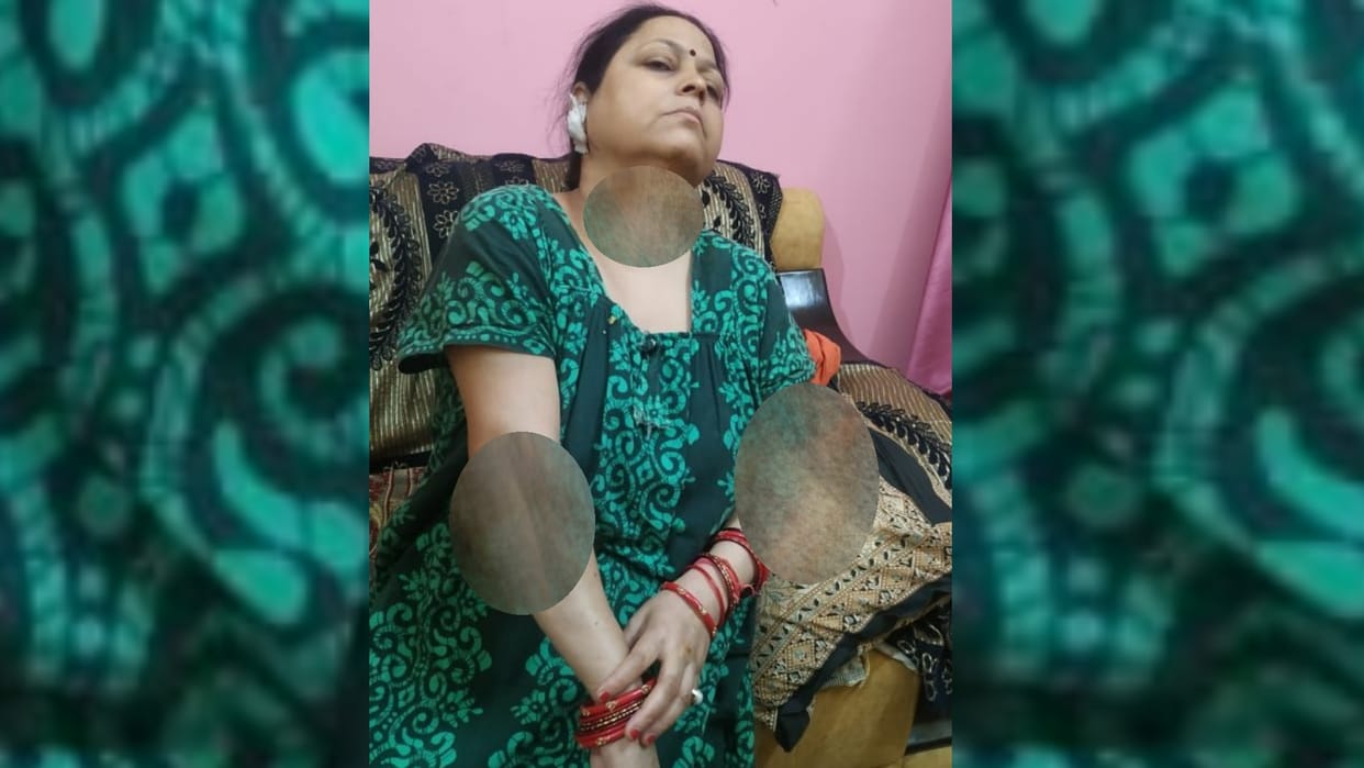 A woman got injured during chain snatching in madiyaon in Lucknow.