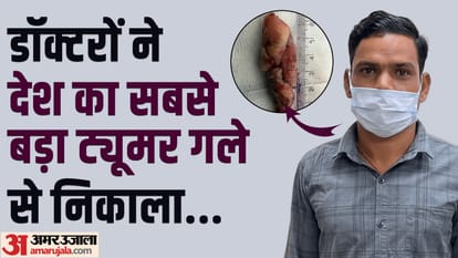खाने की नली से निकाला गया नाशपाती के आकार का ट्यूमर
