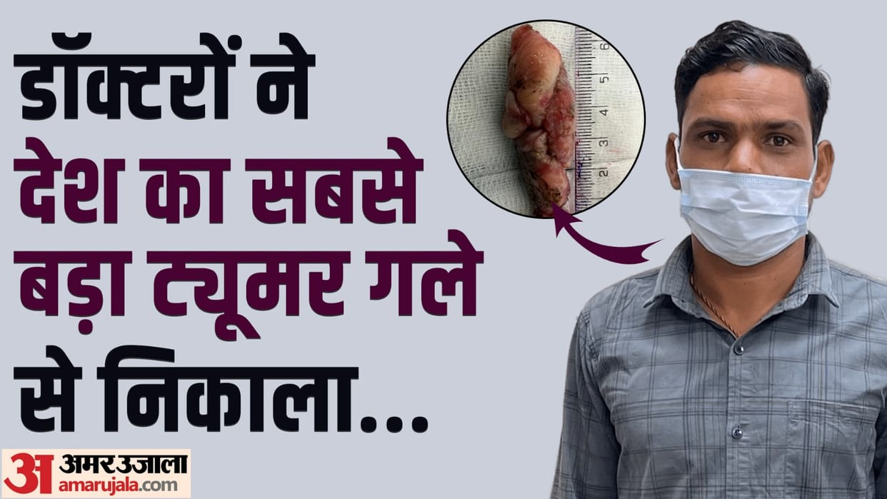 Sir Ganga Ram Hospital doctors removed pear shaped tumor from esophagus of man