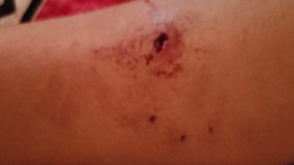 child has been bitten by stray dog in Shri Radha Sky Garden