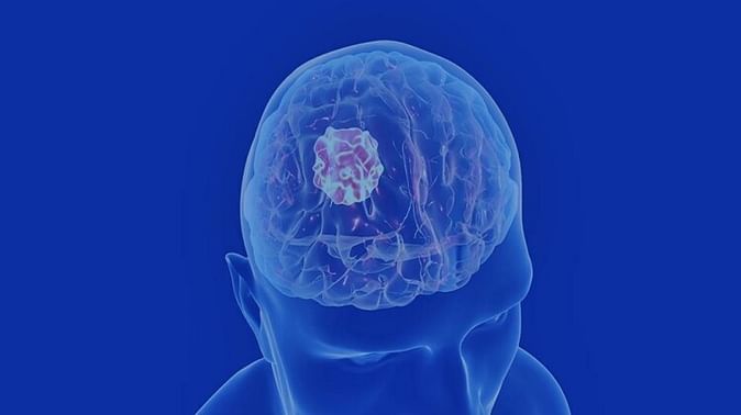फ़ोन का अधिक प्रयोग आपको बना सकता है मस्तिष्क ट्यूमर का शिकार