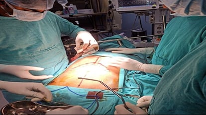 उपलब्धि : 12 साल के बच्चे के लीवर में फैला आंत का कैंसर, एसआरएन में हुई सफल सर्जरी Bowel cancer spread to the liver of a 12-year-old child, successful surgery in SRN