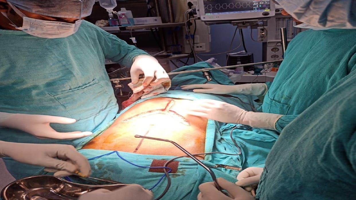 Successful liver cancer surgery for the first time in Prayagraj, doctors of SRN performed the operation