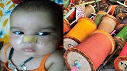 Two and a half month old baby nose cut by Chinese manjha in Bareilly