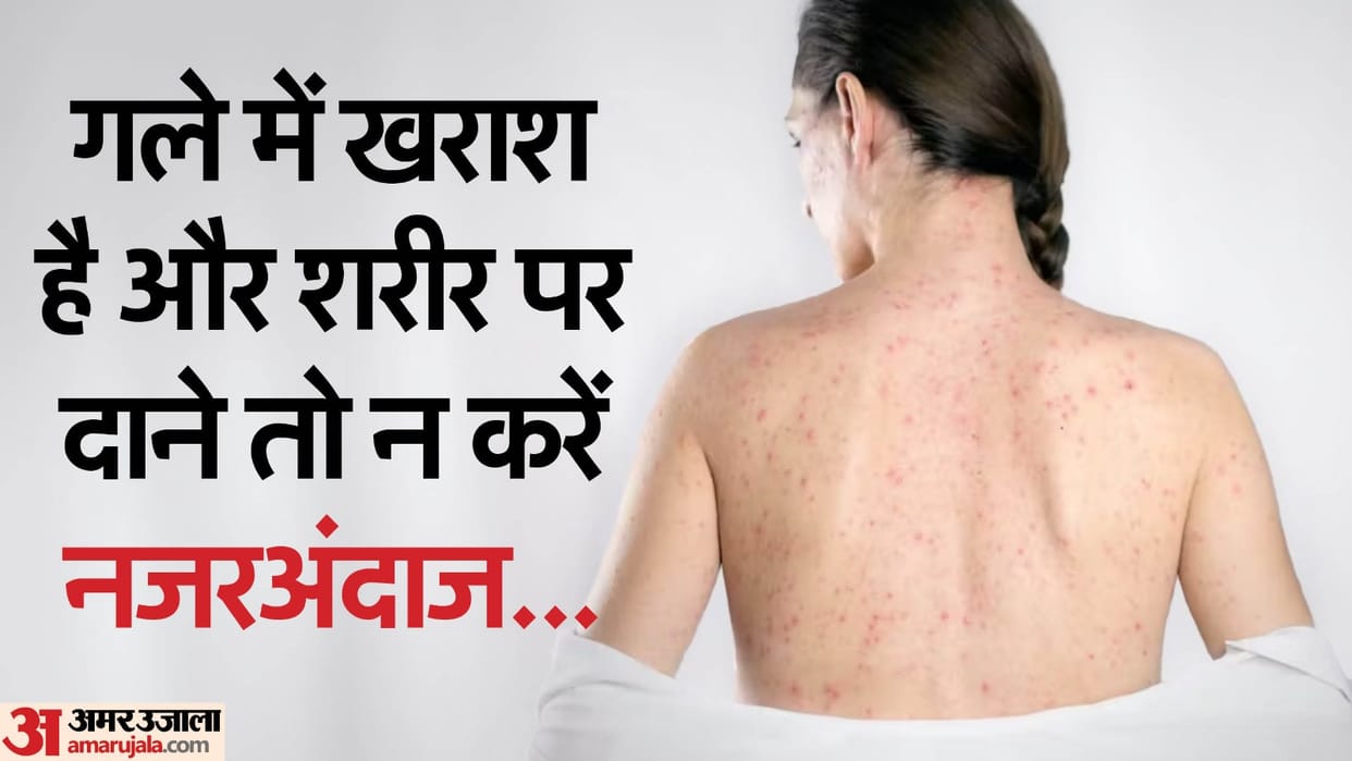 rash started from the face spread all over the body then it can be measles rubella know the remedy