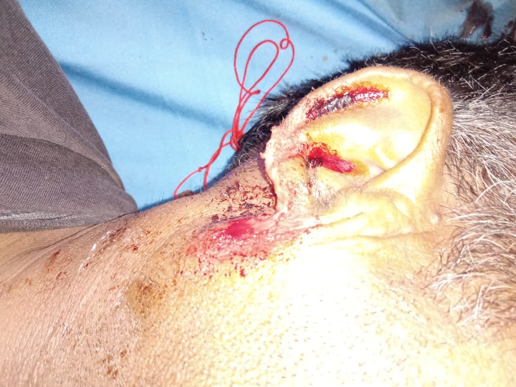 Bhopal News: Dead body kept in mercury in Hamidia Hospital was gnawed by rat, deep freezer also damaged