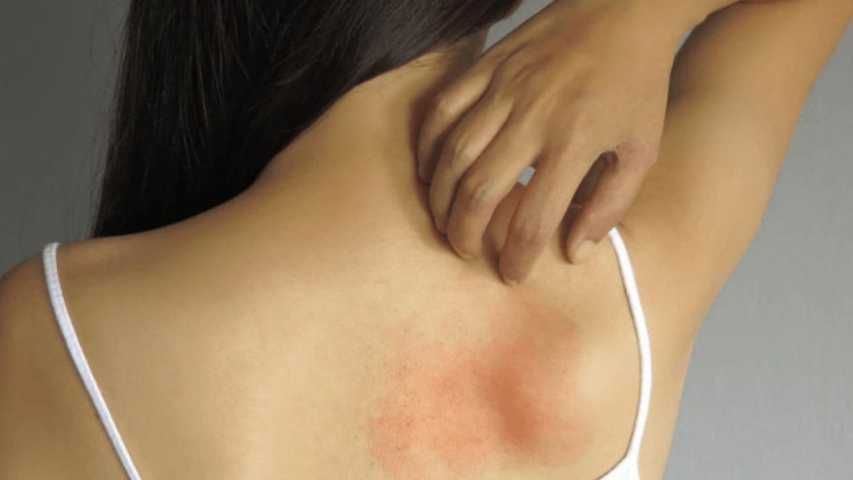 Skin Care How can prevent heat rash prickly heat at home in hindi ghamoriya kaise thik hoti hai