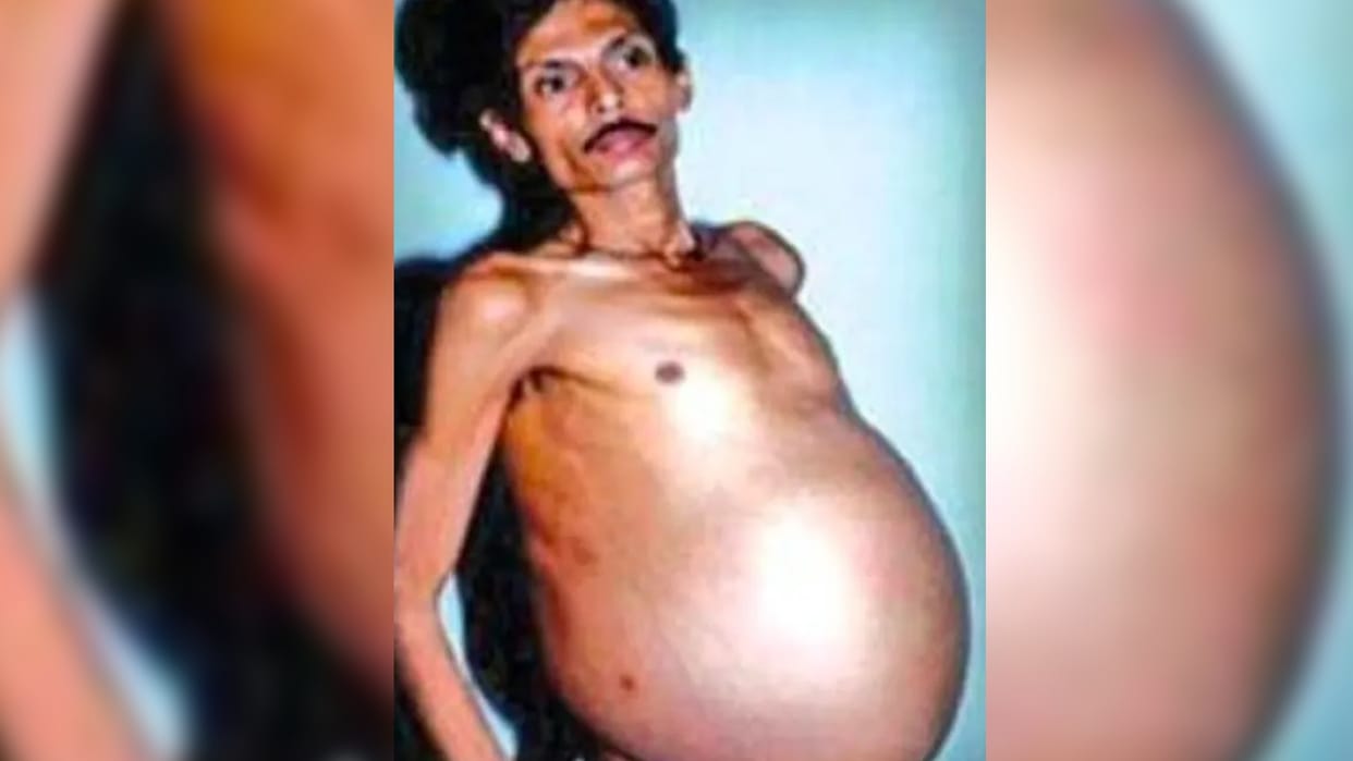 pregnant Man: nagpur man Was pregnant for 36 years with twins know surprising story