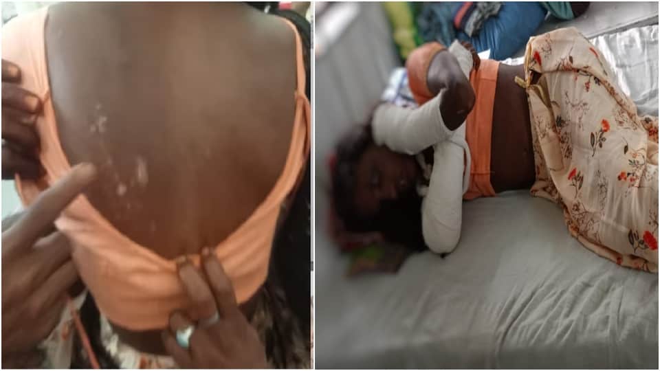 Bhilwara Crime News: Father In Law Tortured Daughter In Law By Calling Her Witch, Burnt With Hot Rods