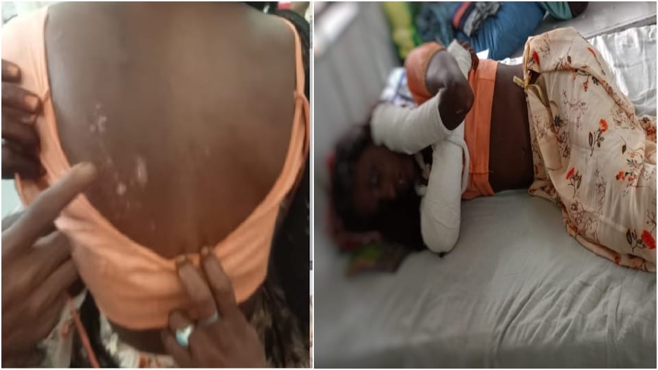 Bhilwara Crime News: Father In Law Tortured Daughter In Law By Calling Her Witch, Burnt With Hot Rods