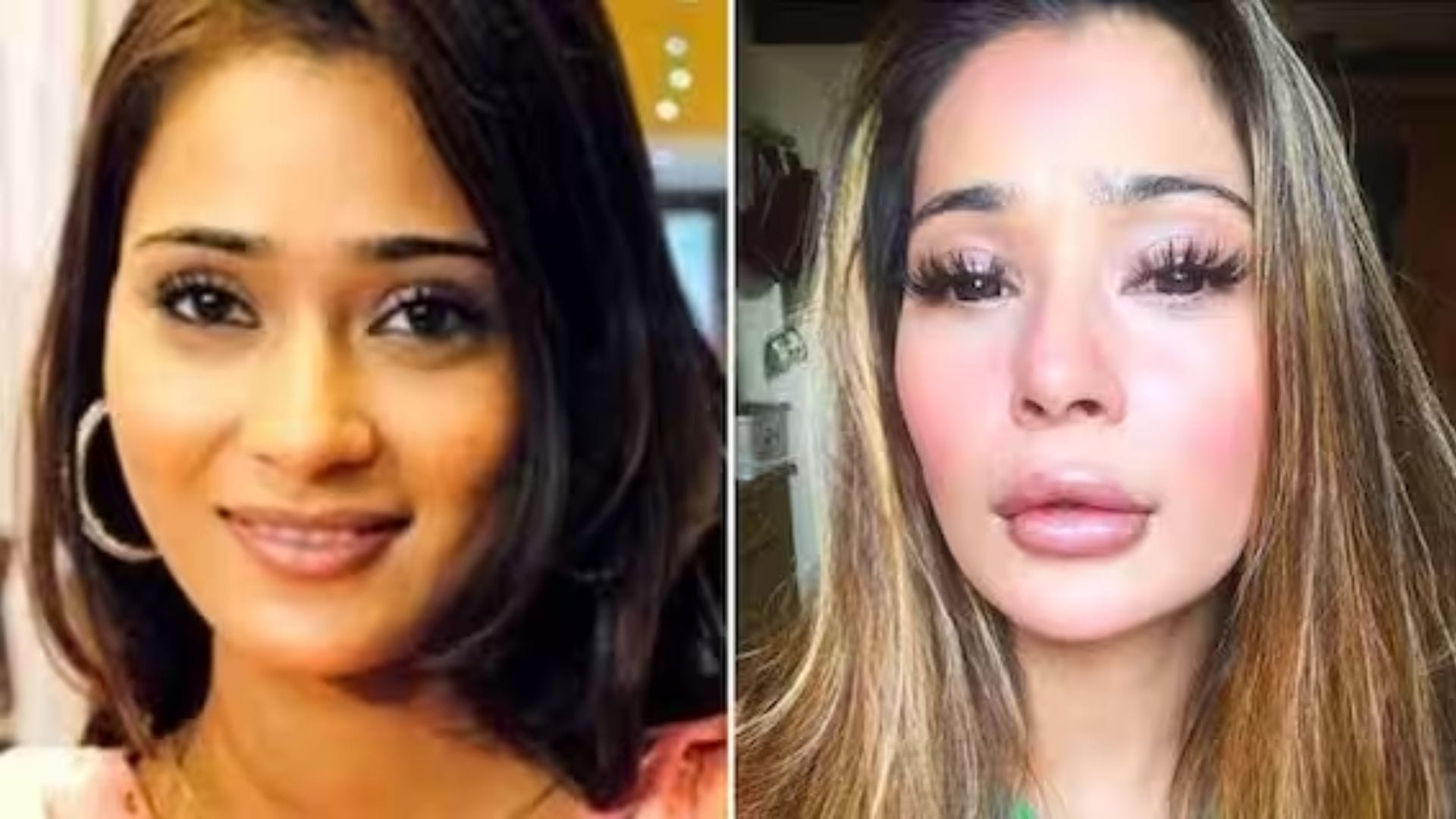 bollywood actresses plastic surgery gone wrong Shruti Haasan Ayesha Takia Sara Khan