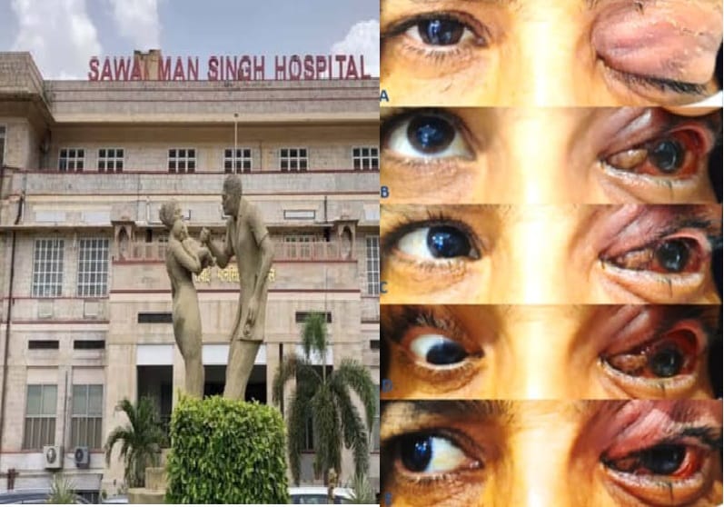 Rajasthan:pseudomonas infection spread in SMS hospital jaipur, 17 patients eyes infected, 3 OT closed