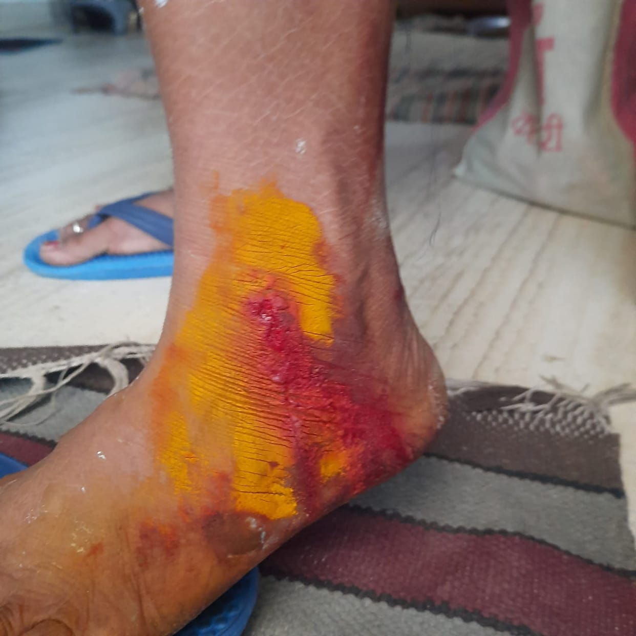 Dog has injured five children in Rau's colony in six days, people stopped coming out of their houses