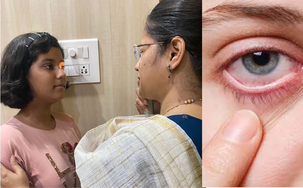 Attack of conjunctivitis intensifies, Eyes are getting red, experts said danger of new strain