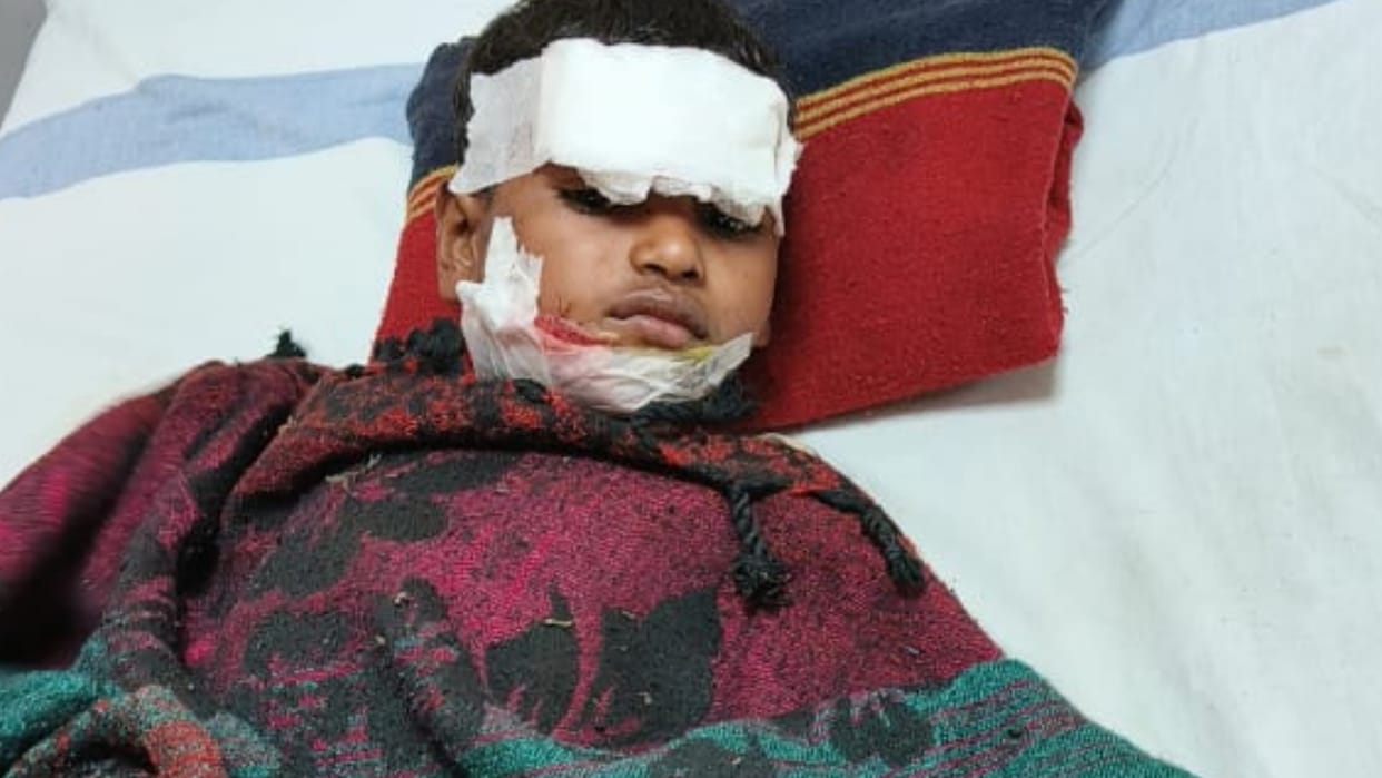 Dog attacked five year old child in Jagdalpur