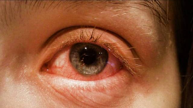 Eye Flu Symptoms Causes and Treatment of conjunctivitis Prevention Tips