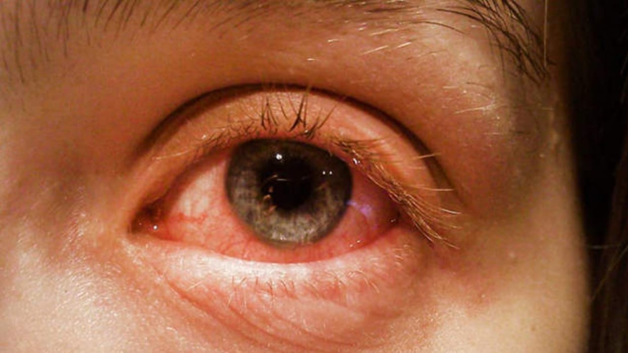 Pink Eye: Conjunctivitis infection spreading in Chhattisgarh, know how to prevent