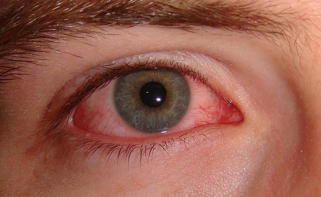 The spread of conjunctivitis is fast, Bacterial infection in eyes with virus, read advisory