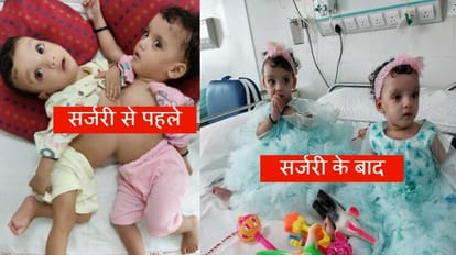 AIIMS doctors separate twin sisters after surgery