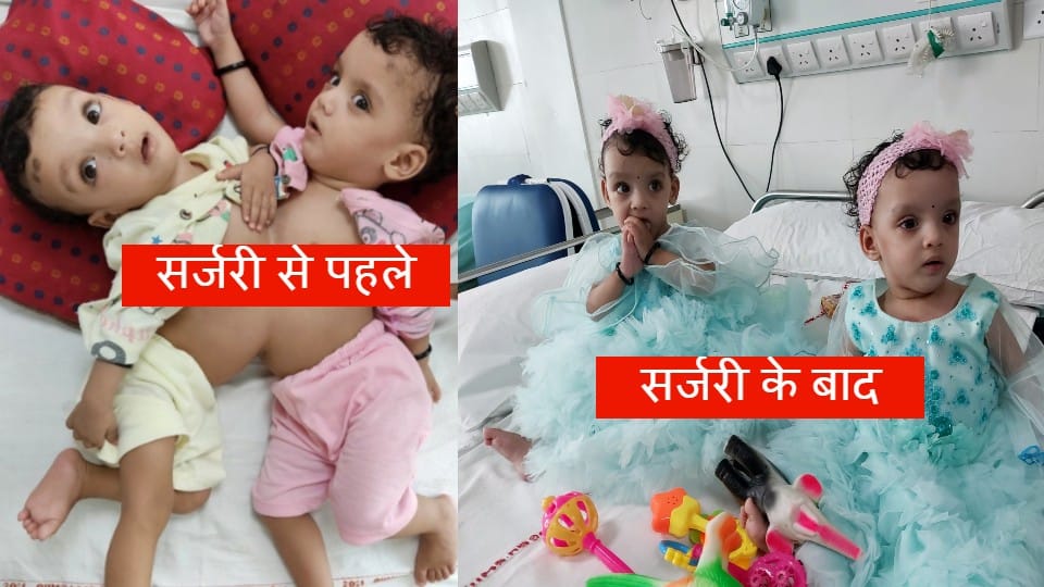 AIIMS doctors separate twin sisters after surgery
