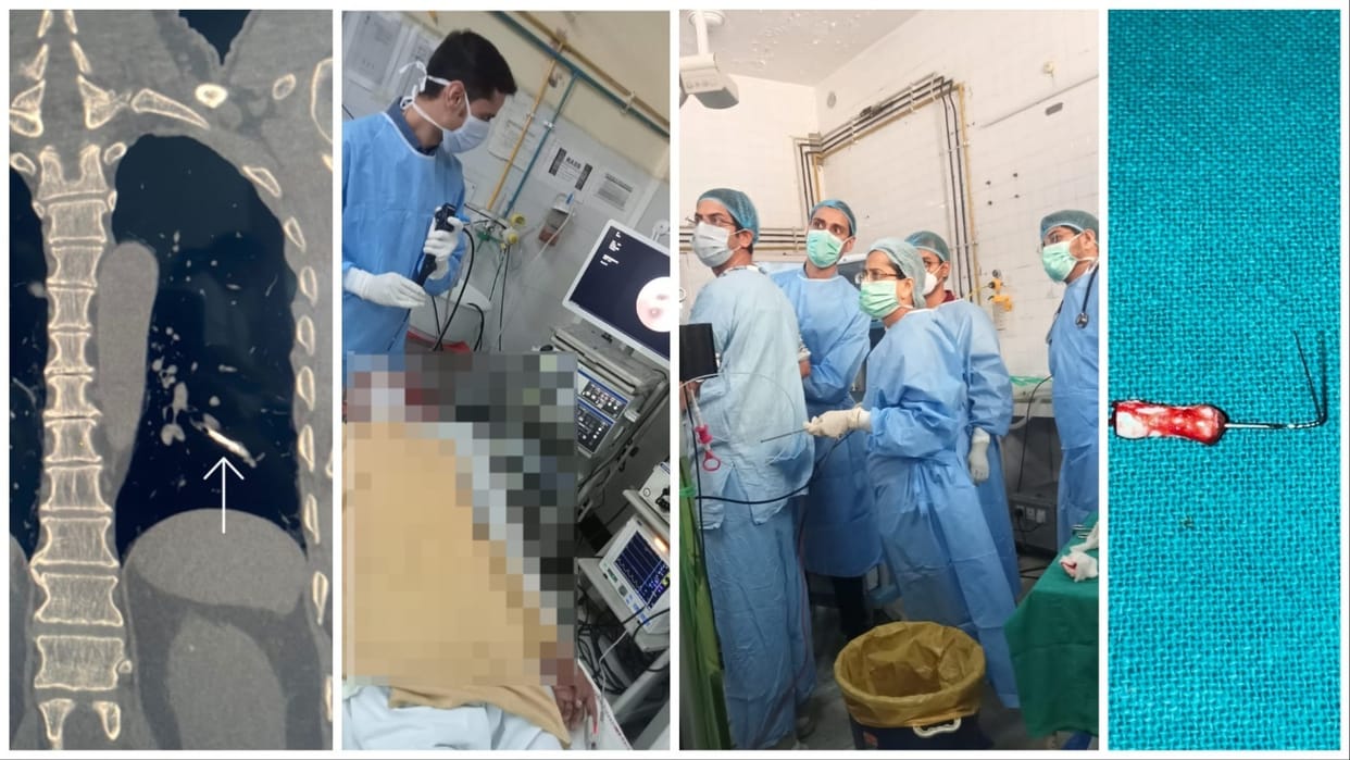 2 inch long needle stuck in trachea removed after 4 hours operation in Rohtak PGI