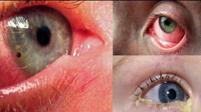 Eye Flu: तेजी से पांव पसार रहा आई फ्लू, आंखों पर काला चश्मा और जेब में मिल रही आई ड्रांप fast spreading eye flu