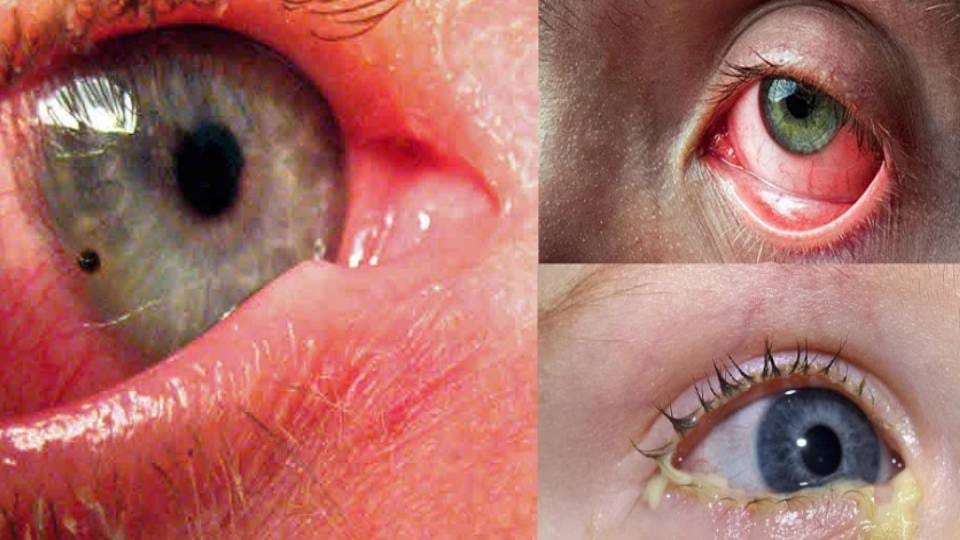 fast spreading eye flu