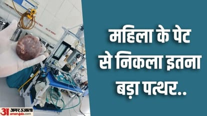 Doctors removed 300 gram bladder stone after surgery in medical college pilibhit