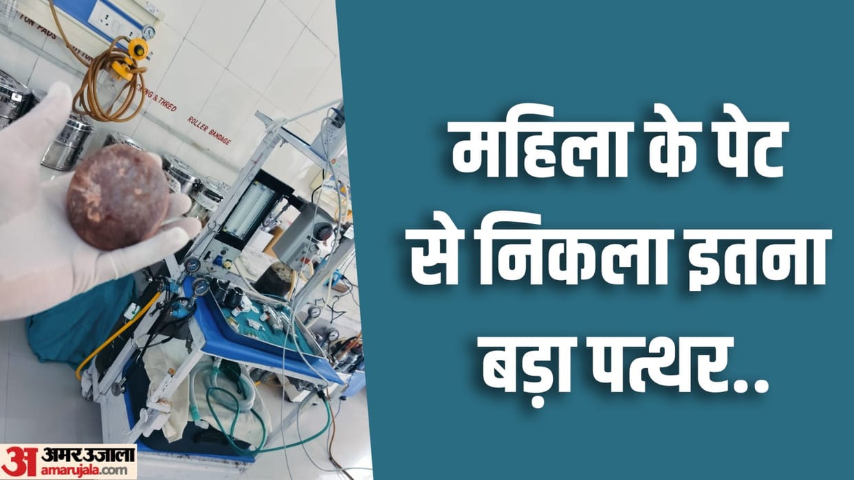 Doctors removed 300 gram bladder stone after surgery in medical college pilibhit