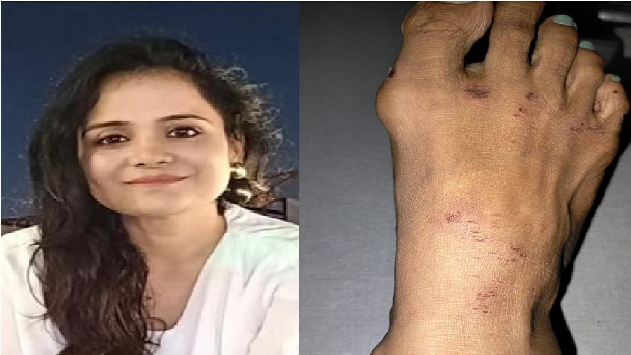 Dogs attacked a woman in Ghaziabad bitten her in eight places