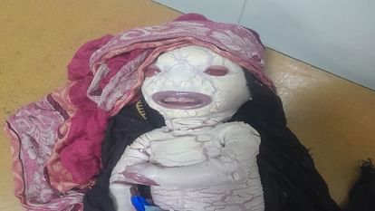 Another Woman Gives Birth To Harlequin Baby like alien In Bareilly