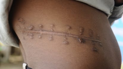 Operation stone and kidney removed, pain on stopping the medicine, revealed on ultrasound