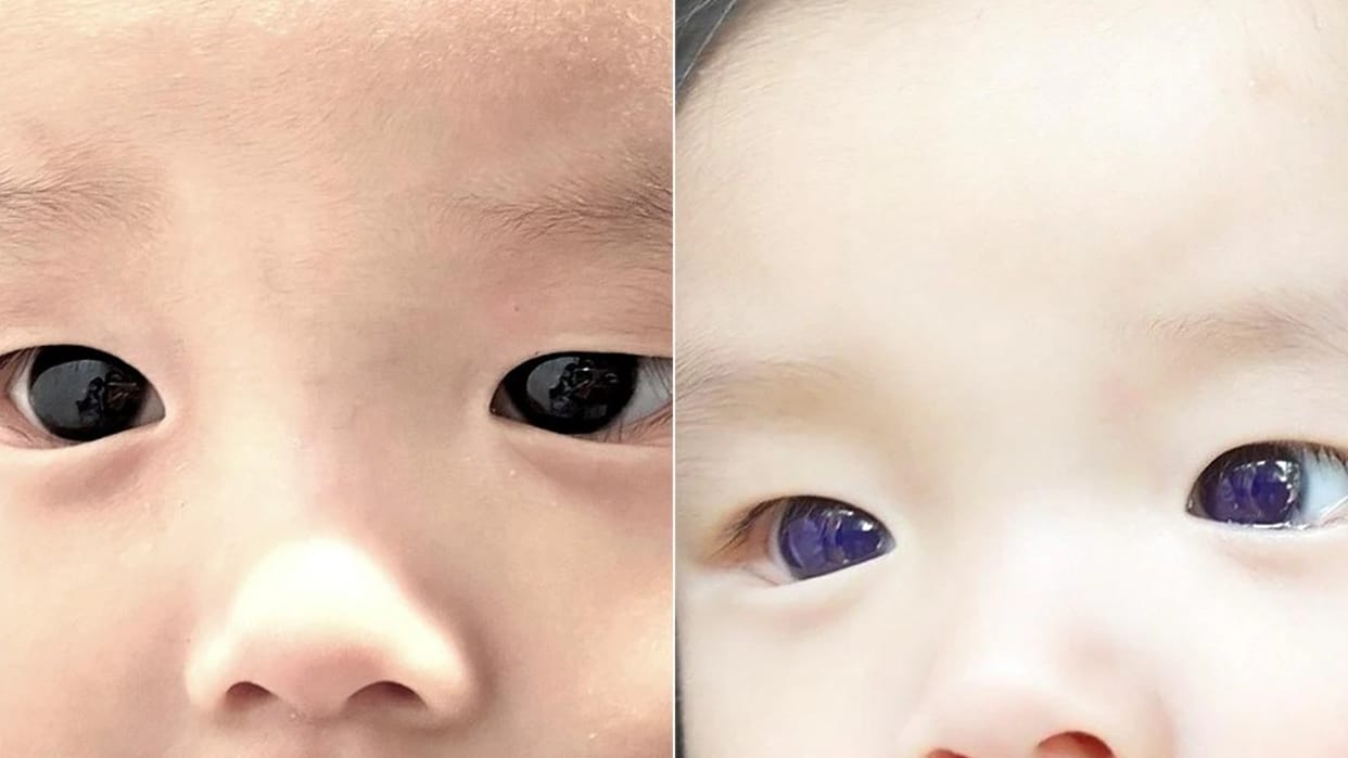 Child's eye color changed during Covid-19 treatment in Thailand
