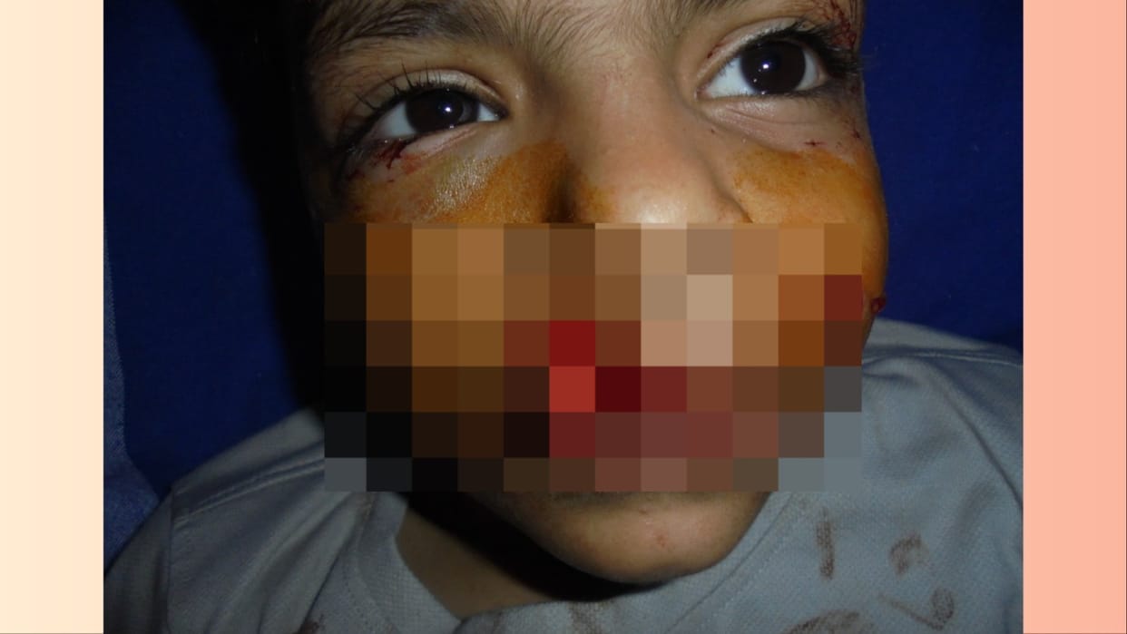 7 year old boy attacked by two pitbull dogs, bitten his lip