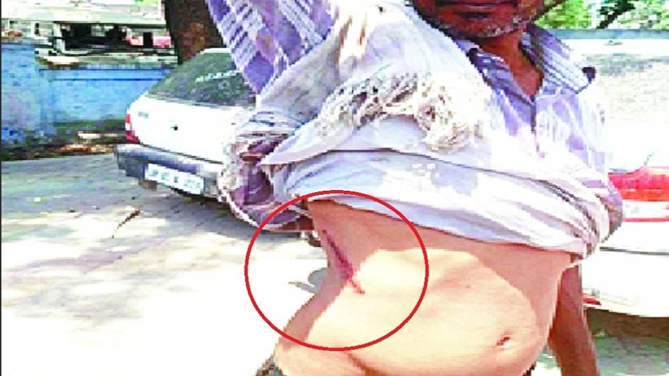 Experts discuss its symptoms and treatment on World Sepsis Day in Agra