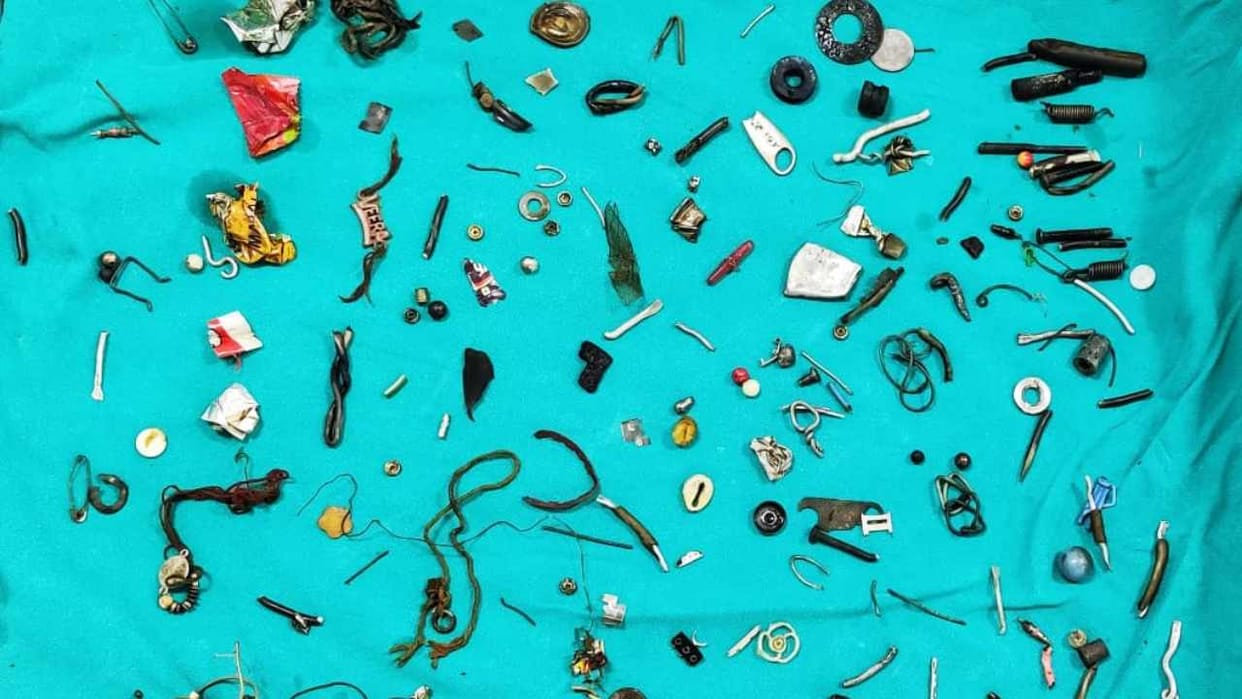 Doctors operated on removing earphones nuts bolts and screws from a person's stomach in Moga