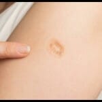 vaccine mark on body