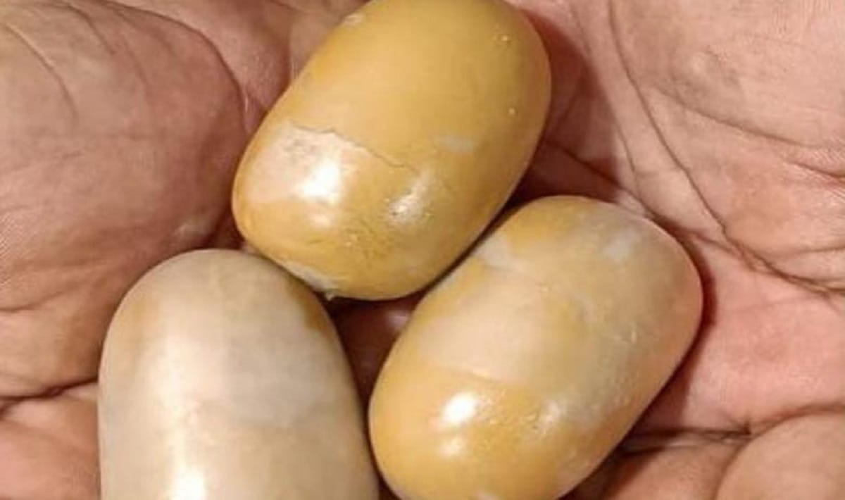 passenger coming from Sharjah hidden gold worth Rs 49 lakh in his rectum team of doctors at varanasi airport