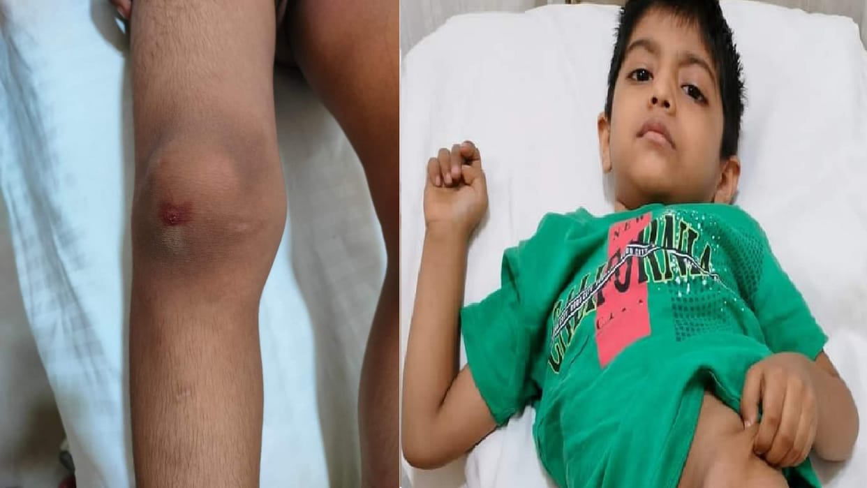 Dogs attack on children in Raj Nagar Extension Ghaziabad