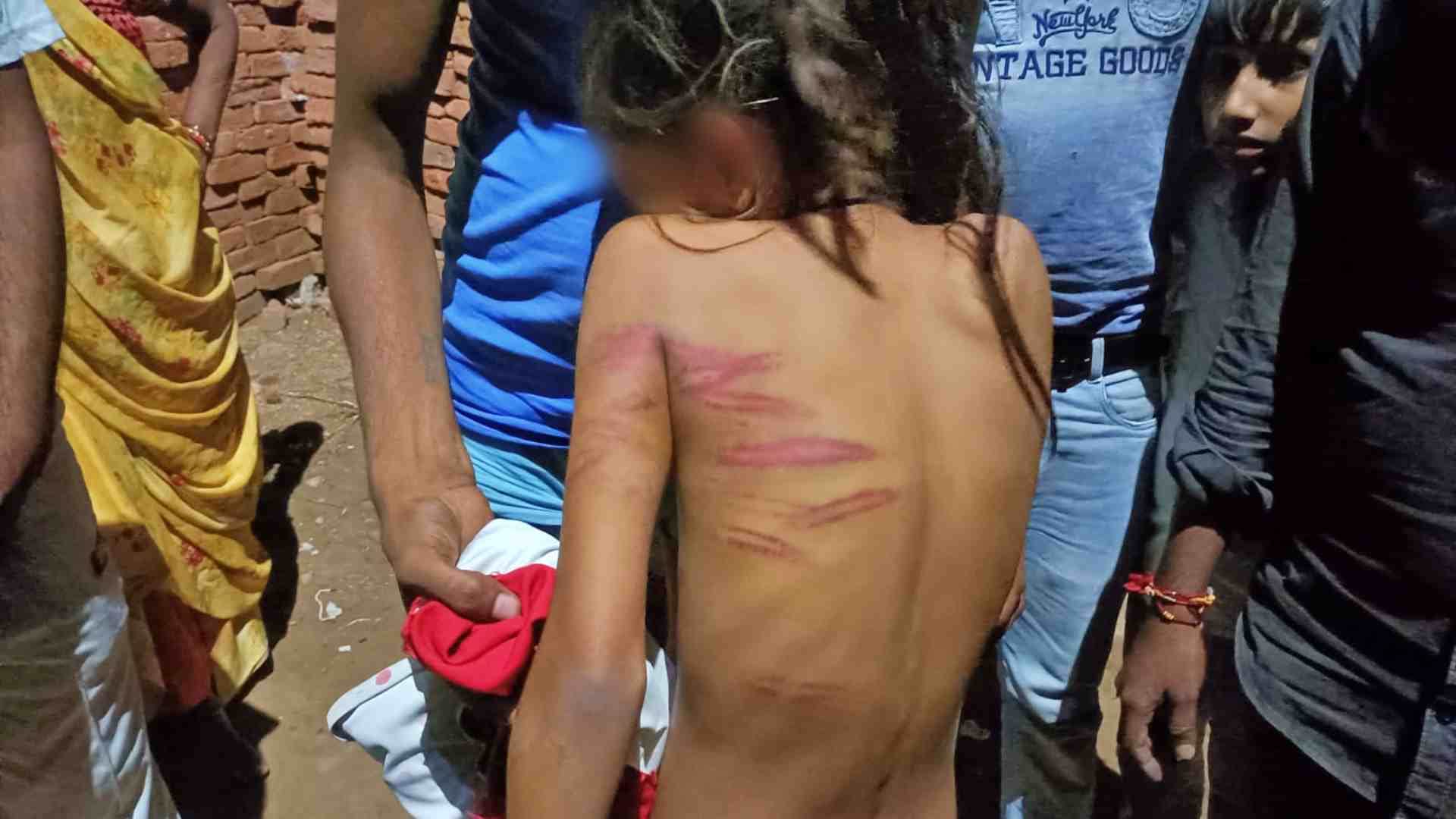 बालिका के पीठ पर पिटाई के निशान।