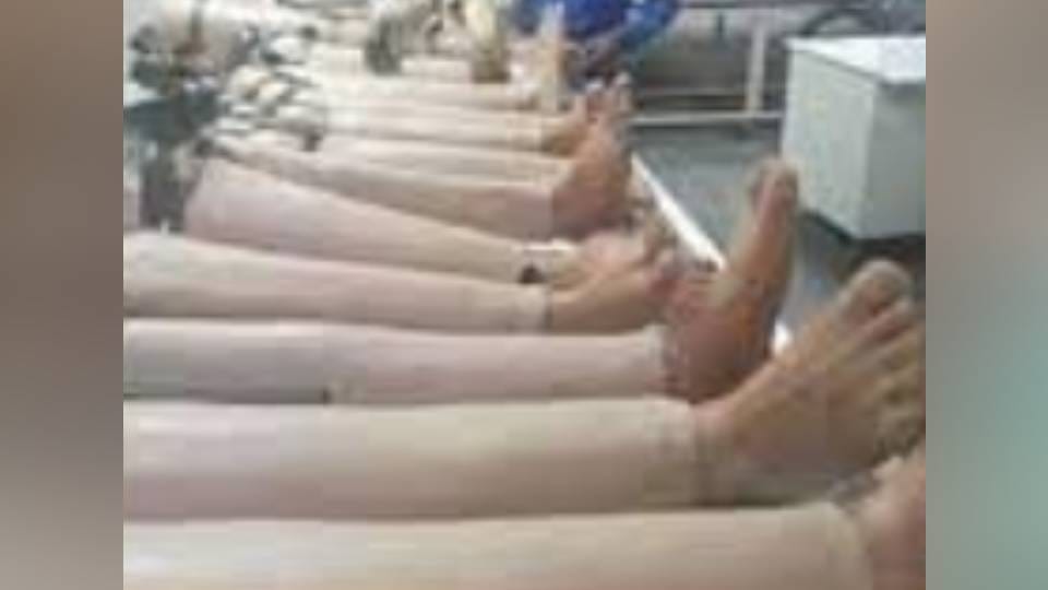 Now hi tech artificial hands and legs will be made in Agra