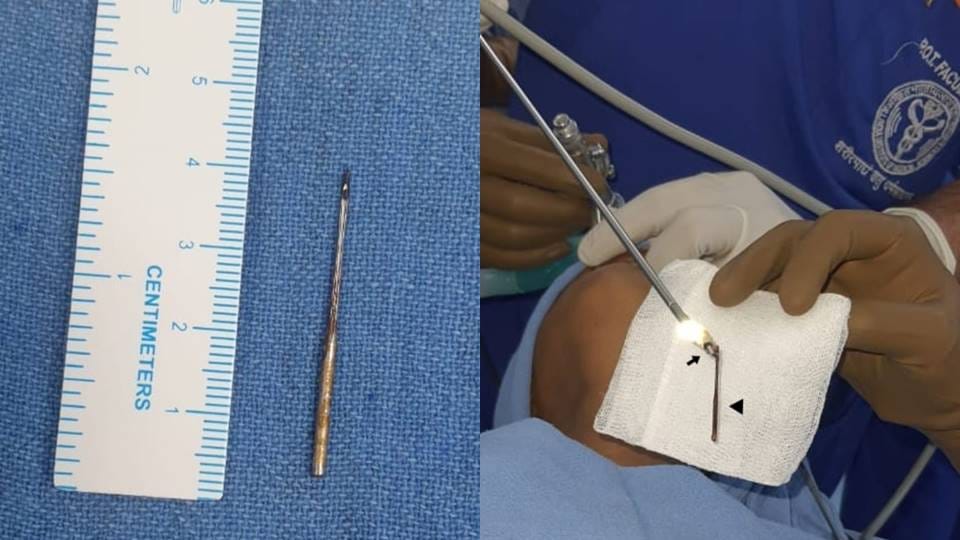 AIIMS doctors removed a needle used to sew clothes from the chest of a 7-year-old child