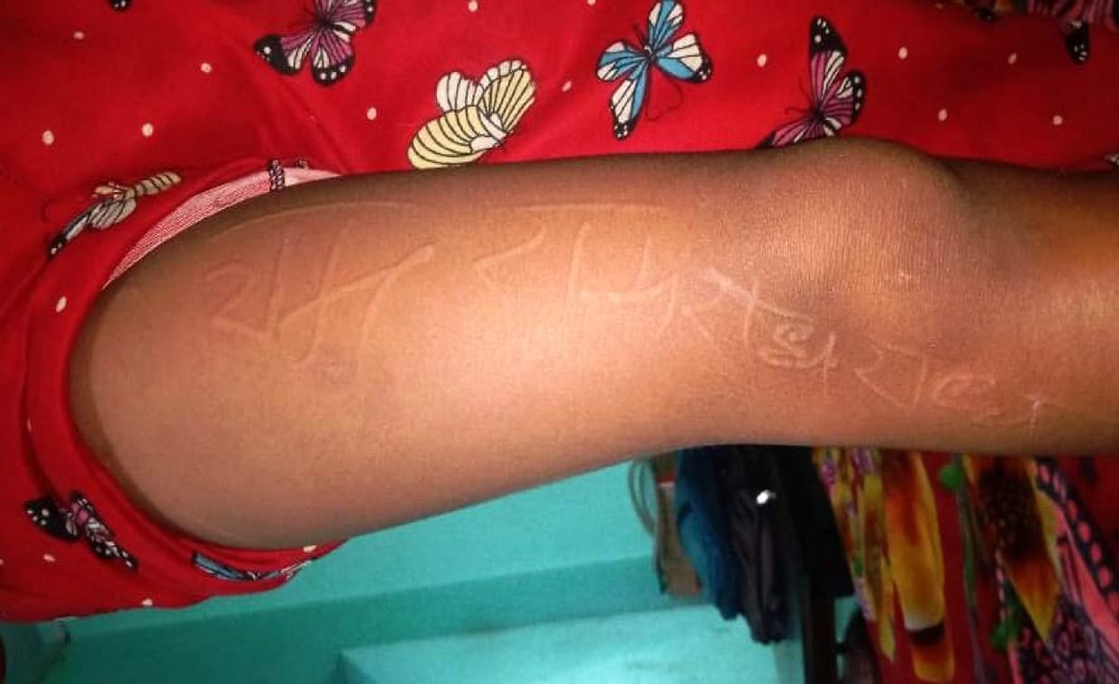 Words named Ram and Radhe are emerging on the body of the student, doctors could not tell anything