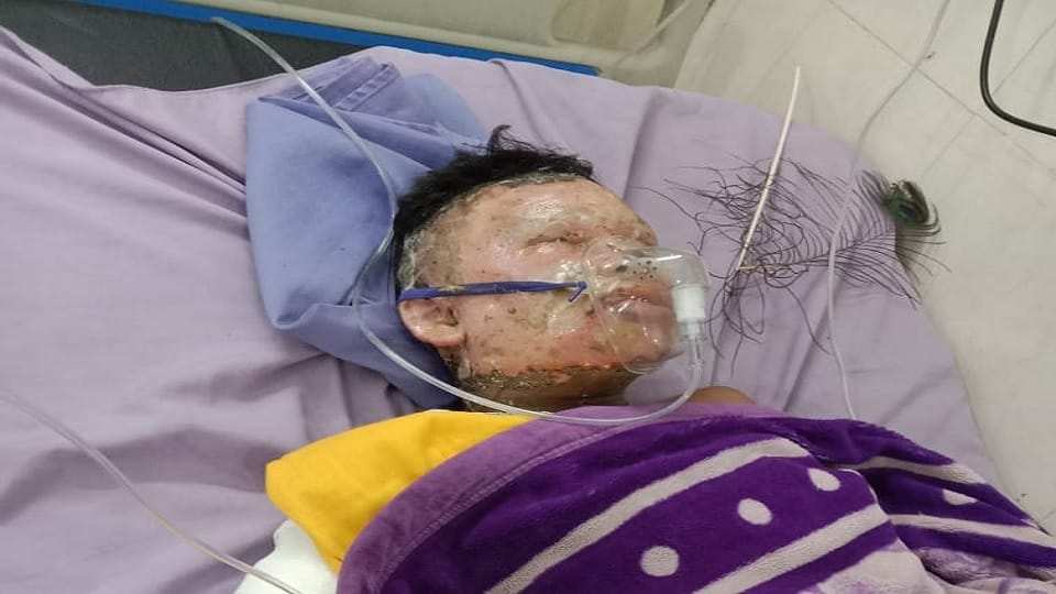 Explosion while grinding sulfur and potash in Panipat, 13 year old child burnt